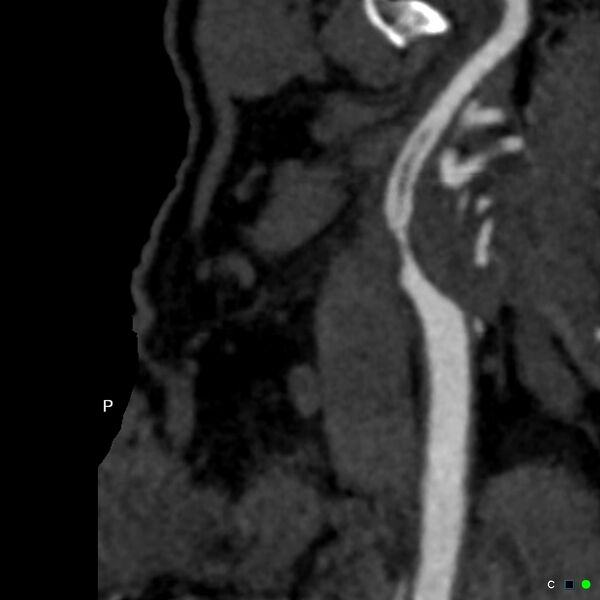 File:Non-occlusive intraluminal internal carotid artery thrombus (Radiopaedia 37751-39658 A 14).jpg