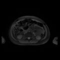 Normal MRI abdomen in pregnancy (Radiopaedia 88001-104541 D 27).jpg
