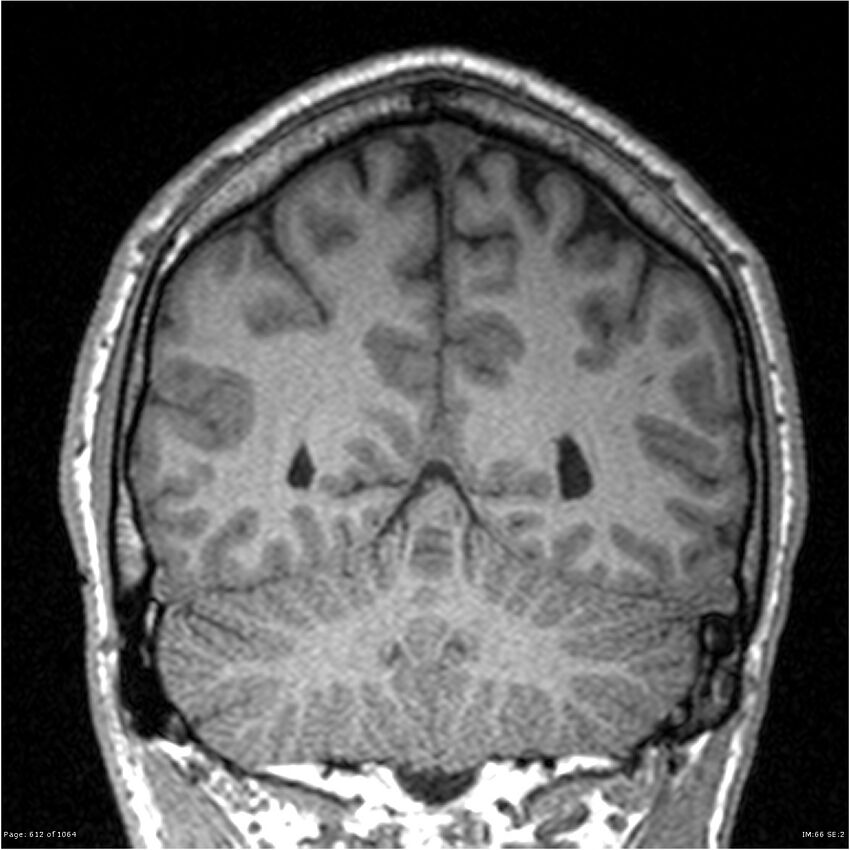Normal brain MRI (non-focal epilepsy protocol) (Radiopaedia 38571-40700 Coronal T1 32).jpg