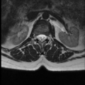 Normal cervical and thoracic spine MRI (Radiopaedia 35630-37156 H 3).png