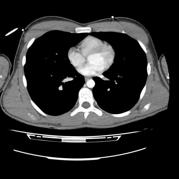 File:Normal dual-phase trauma CT chest,abdomen and pelvis (Radiopaedia 48092-52899 A 33).jpg