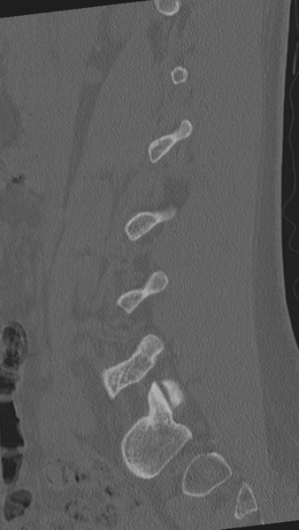 File:Normal lumbar spine CT (Radiopaedia 46533-50986 Sagittal bone window 67).png