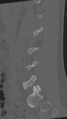Normal lumbar spine CT (Radiopaedia 46533-50986 Sagittal bone window 67).png