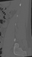 Normal lumbar spine CT (Radiopaedia 46533-50986 Sagittal bone window 79).png
