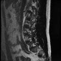 Normal lumbar spine MRI (Radiopaedia 35543-37039 Sagittal T2 11).png