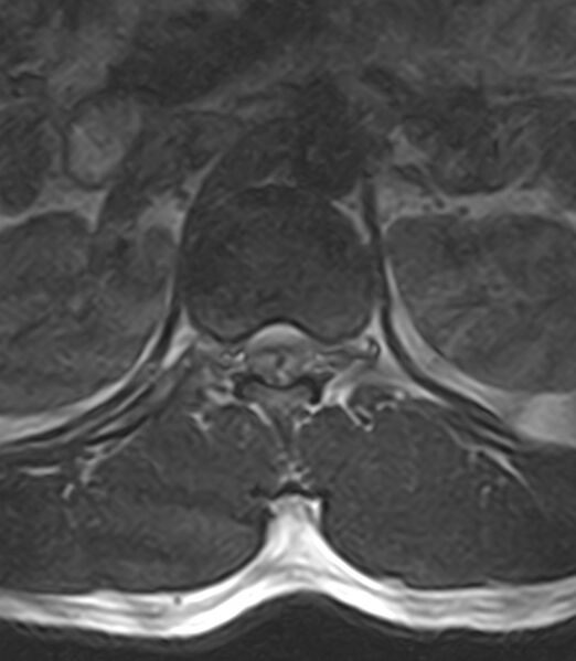 File:Normal lumbar spine MRI - low-field MRI scanner (Radiopaedia 40976-43699 Axial T2 16).jpg