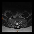 Normal spine MRI (Radiopaedia 77323-89408 Axial T2 28).jpg
