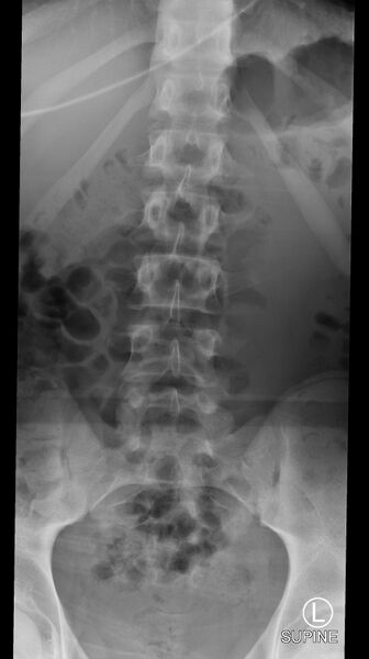 File:Normal trauma spine imaging (age 16) (Radiopaedia 45335-49357 D 1).jpg