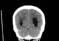 Obstructive hydrocephalus (Radiopaedia 30453-31119 Coronal non-contrast 32).jpg