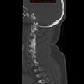 Occipital condyle fracture (Radiopaedia 18366-18208 Sagittal bone window 30).jpg