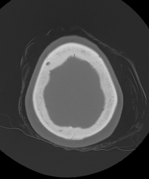 File:Occipital condyle fracture (Radiopaedia 61165-69056 Axial bone window 4).jpg