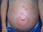 Pemphigoid gestationis (DermNet NZ immune-pemgest1).jpg