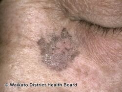 Pigmented actinic keratosis (DermNet NZ facial-lesion-08).jpg