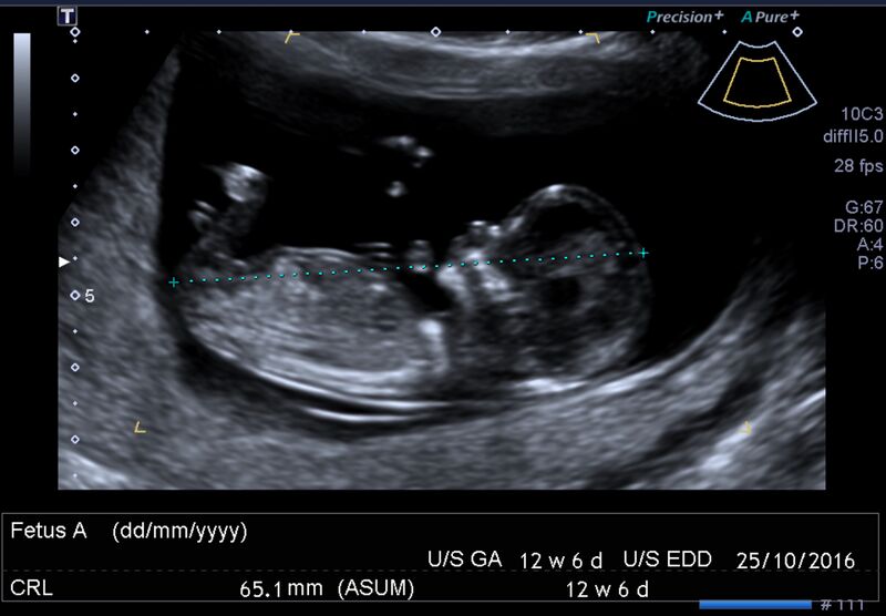 File:1st trimester nuchal-morphology ultrasound (Radiopaedia 44706-48477 General anatomy and NT 2).jpg