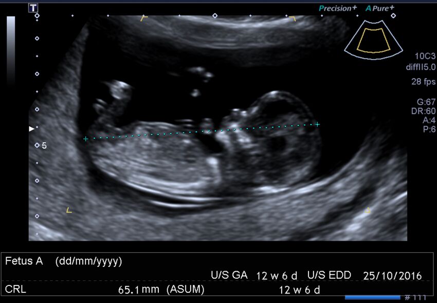 1st trimester nuchal-morphology ultrasound (Radiopaedia 44706-48477 General anatomy and NT 2).jpg