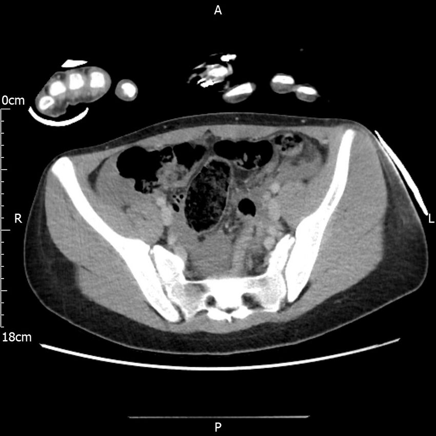 AAST grade IV kidney injury with CEUS follow-up (Radiopaedia 72353-82877 Axial C+ portal venous phase 59).jpg