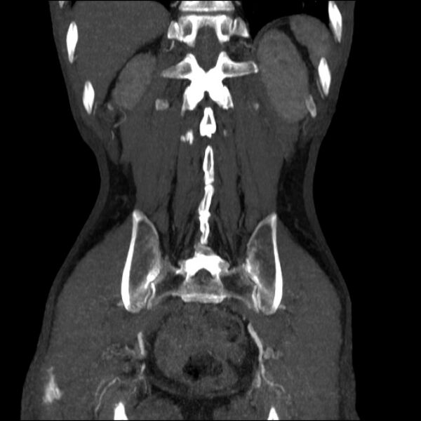 File:Abdominal aortic aneurysm (Radiopaedia 23703-23856 Coronal C+ arterial phase 30).jpg
