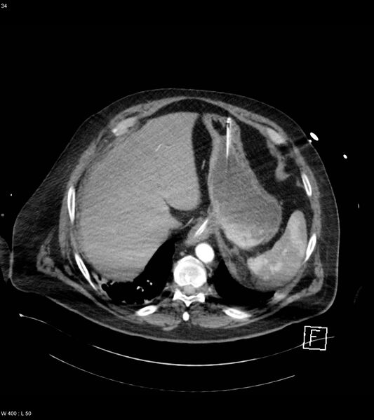 File:Abdominal aortic aneurysm with intramural hematoma then rupture (Radiopaedia 50278-55632 Axial C+ arterial phase 33).jpg