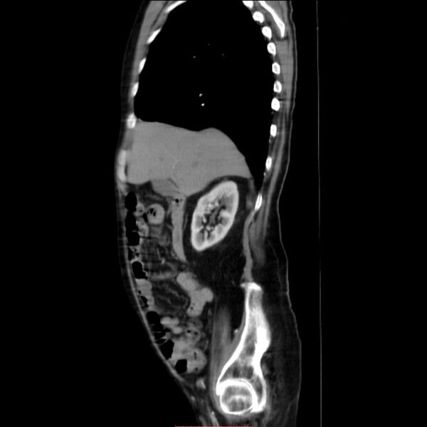 File:Abdominal aortic interposition tube graft and aneurysm thrombosis (Radiopaedia 71438-81857 Sagittal C+ arterial phase 25).jpg