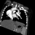 Aberrant left pulmonary artery (pulmonary sling) (Radiopaedia 42323-45435 Coronal C+ CTPA 13).jpg