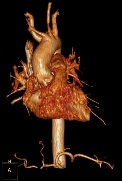 File:Aberrant right subclavian artery (Radiopaedia 67135-76475 B 15).jpg