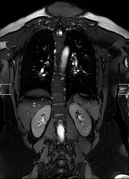 File:Aberrant right subclavian artery with background Takayasu arteritis (Radiopaedia 21423-21363 Coronal MRA 27).jpg