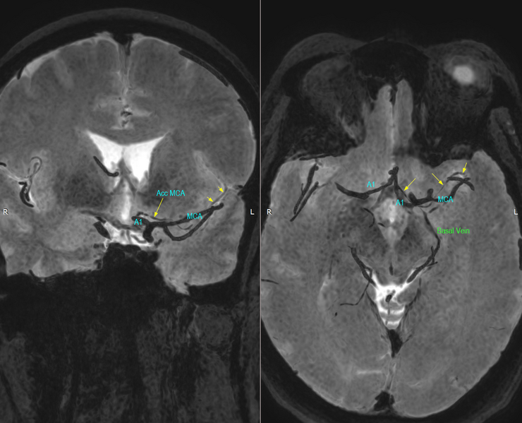 File:Accessory middle cerebral artery (Radiopaedia 73114-83829 Axial & Coronal 1).png