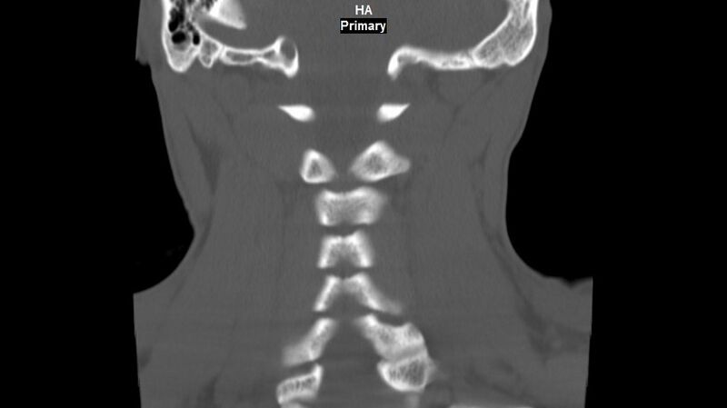 File:Accessory ossicle of the anterior arch of C1 vertebra (Radiopaedia 58149-65211 Coronal bone window 12).jpg