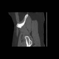 Acetabular fracture (Radiopaedia 13193-13212 Sagittal bone window 13).jpg