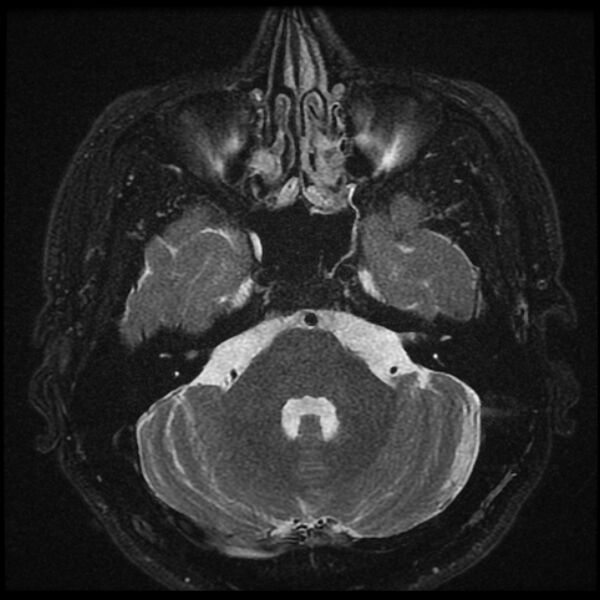 File:Acoustic schwannoma - intracanalicular (Radiopaedia 37247-39024 Axial T2 fat sat 8).jpg