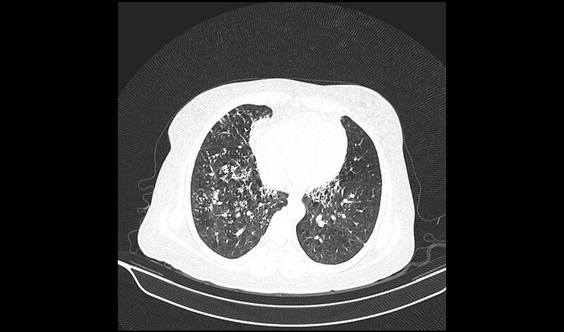 File:Acquired tracheo-esophageal fistula (Radiopaedia 51356-57103 Axial lung window 30).jpg