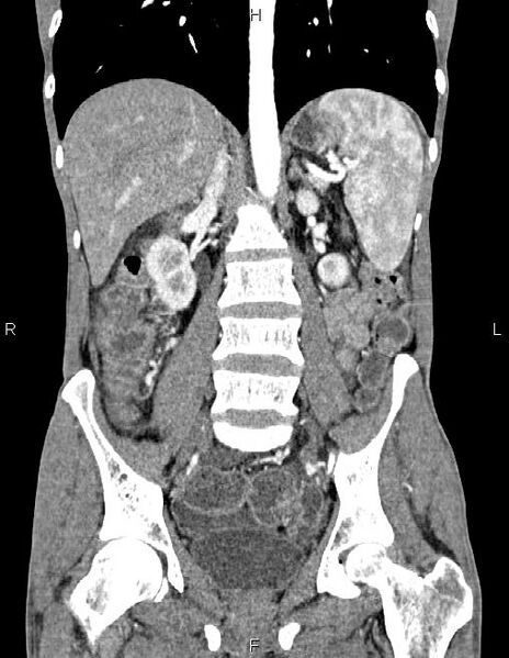File:Active crohn disease (Radiopaedia 87133-103397 Coronal C+ arterial phase 39).jpg