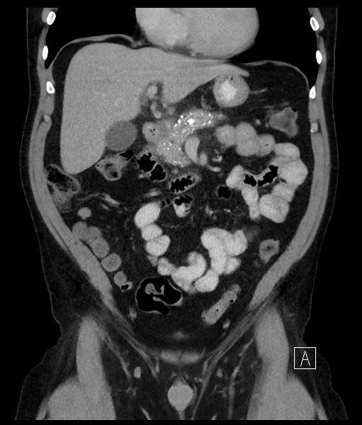 File:Acute-on-chronic pancreatitis (Radiopaedia 67286-76656 Coronal C+ portal venous phase 33).jpg