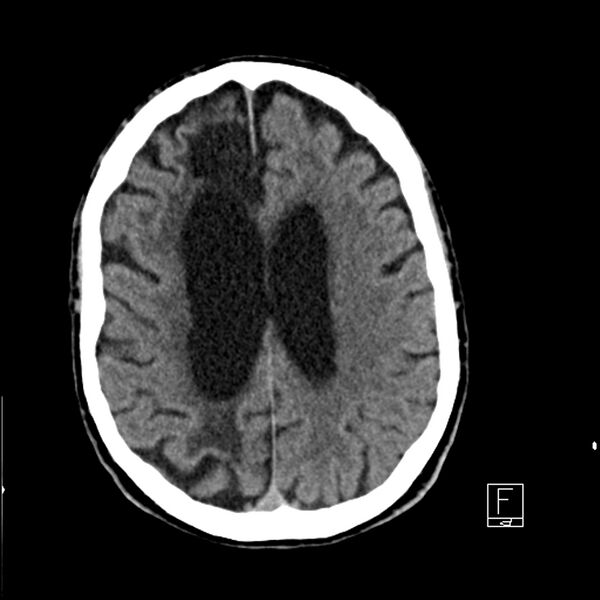 File:Acute ICA ischemic penumbra due to high-grade CCA stenosis (CT perfusion) (Radiopaedia 72038-82529 Axial non-contrast 32).jpg