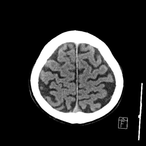File:Acute P1 occlusion with PCA ischemia penumbra (CT perfusion) (Radiopaedia 72084-82586 Axial non-contrast 39).jpg