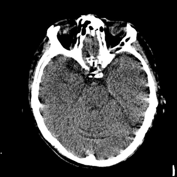 File:Acute P1 occlusion with PCA ischemia penumbra (CT perfusion) (Radiopaedia 72084-82586 Axial non-contrast thins 1).jpg