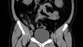 Acute appendicitis (Radiopaedia 13030-13091 Coronal non-contrast 10).jpg
