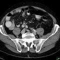 Acute appendicitis arising from a malrotated cecum (Radiopaedia 19970-19997 Axial C+ portal venous phase 30).jpg