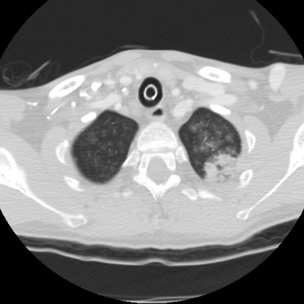 File:Acute diffuse alveolar hemorrhage (Radiopaedia 41323-44158 Axial lung window 2).jpg