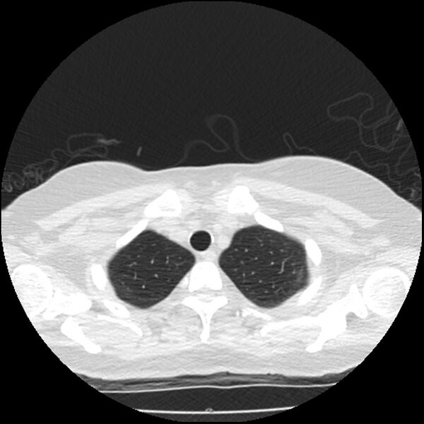 File:Acute interstitial pneumonitis (Radiopaedia 45404-49444 Axial lung window 13).jpg