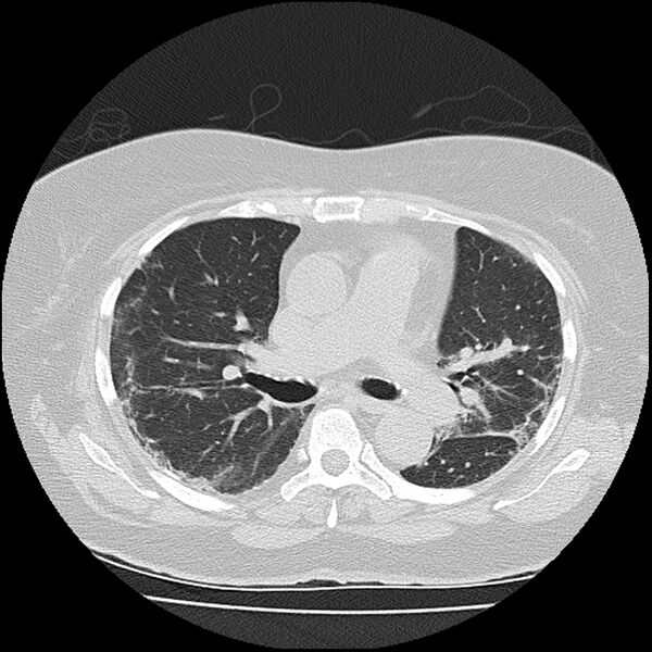 File:Acute interstitial pneumonitis (Radiopaedia 45404-49452 Axial lung window 42).jpg