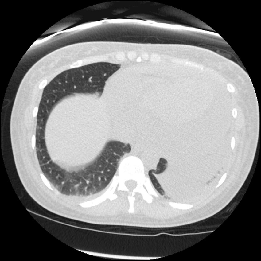 Acute lupus nephritis (Radiopaedia 45832-50107 Axial lung window 76).jpg