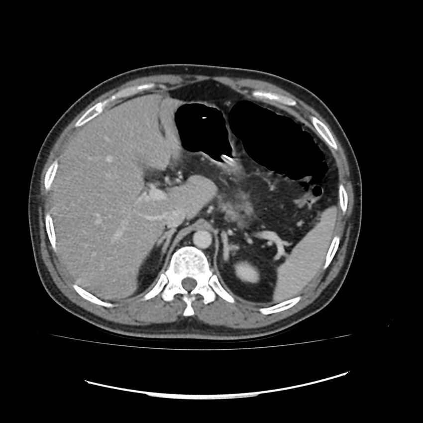 Acute mesenteric ischemia - superior mesenteric artery thrombosis (Radiopaedia 73947-84776 Axial C+ portal venous phase 10).jpg