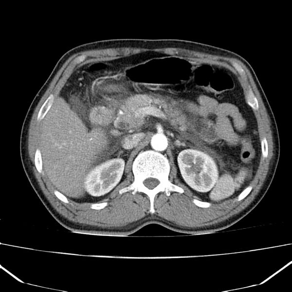 File:Acute pancreatitis (Radiopaedia 22572-22596 Axial C+ arterial phase 26).jpg