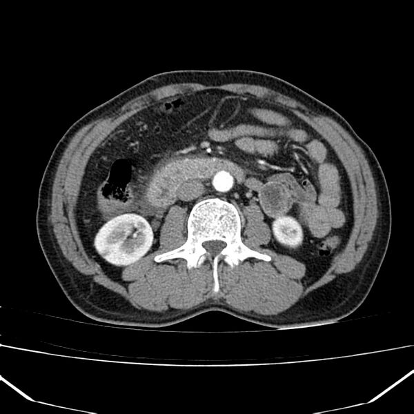 File:Acute pancreatitis (Radiopaedia 22572-22596 Axial C+ arterial phase 38).jpg