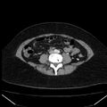 Acute pancreatitis - Balthazar C (Radiopaedia 26569-26714 Axial C+ arterial phase 59).jpg