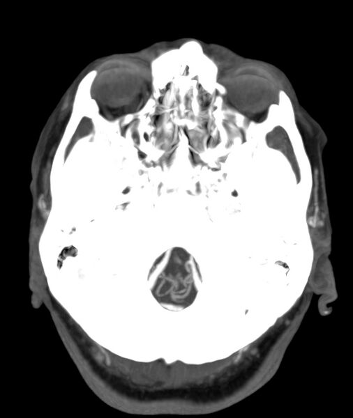 File:Acute right MCA M1 occlusion (Radiopaedia 62268-70454 Axial Phase 2 27).jpg