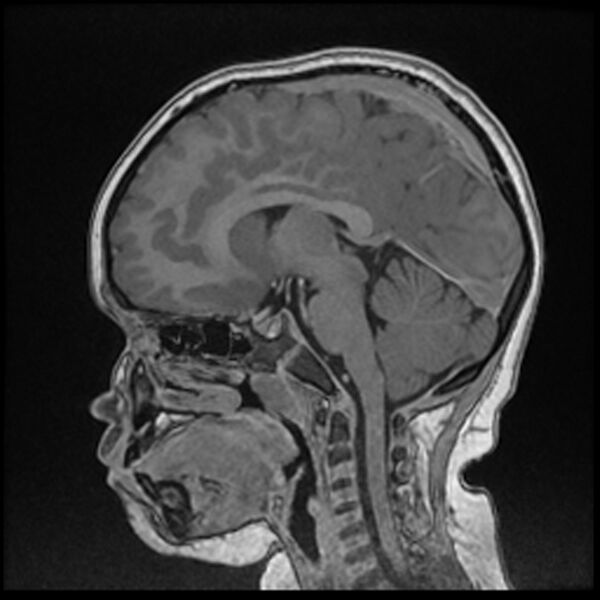 File:Adamantinomatous craniopharyngioma (Radiopaedia 77407-89529 Sagittal T1 C+ 72).jpg