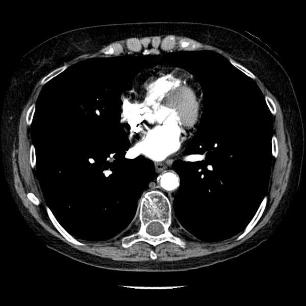 File:Adenocarcinoma of the lung (Radiopaedia 41015-43755 Axial C+ portal venous phase 74).jpg