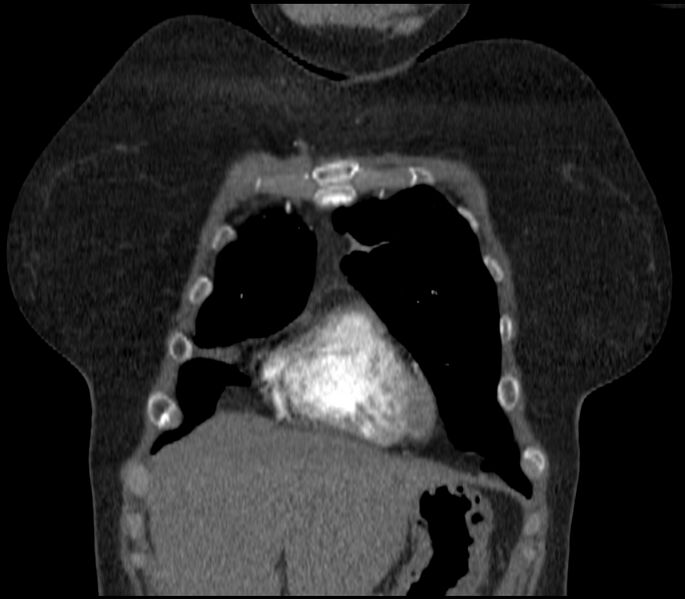 File:Adenocarcinoma of the lung (Radiopaedia 44205-47803 Coronal C+ portal venous phase 15).jpg